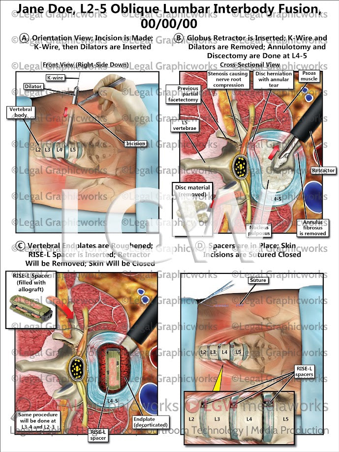 L2-5 Oblique Lumbar Interbody Fusion