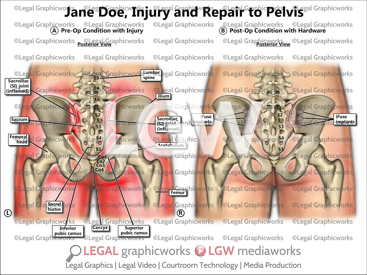 Injury and Repair to Pelvis