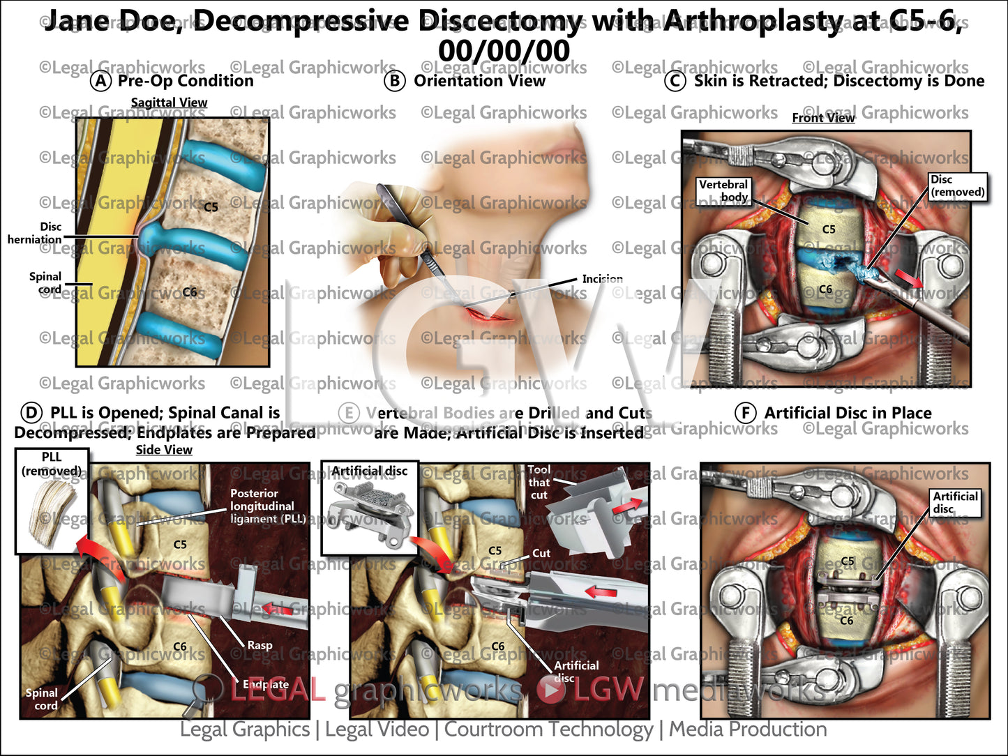 Decompressive Discectomy with Arthroplasty at C5-6