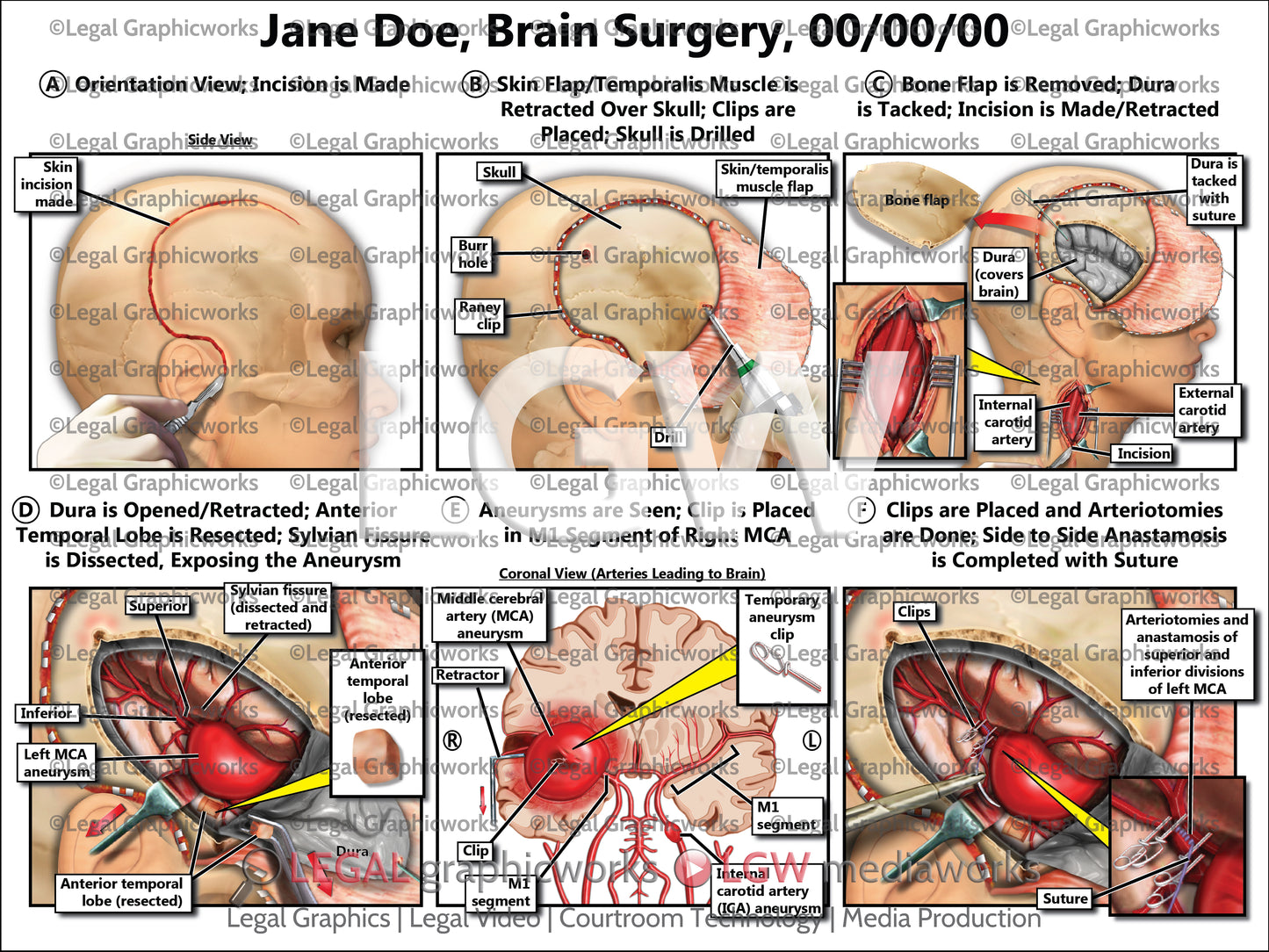 Brain Surgery