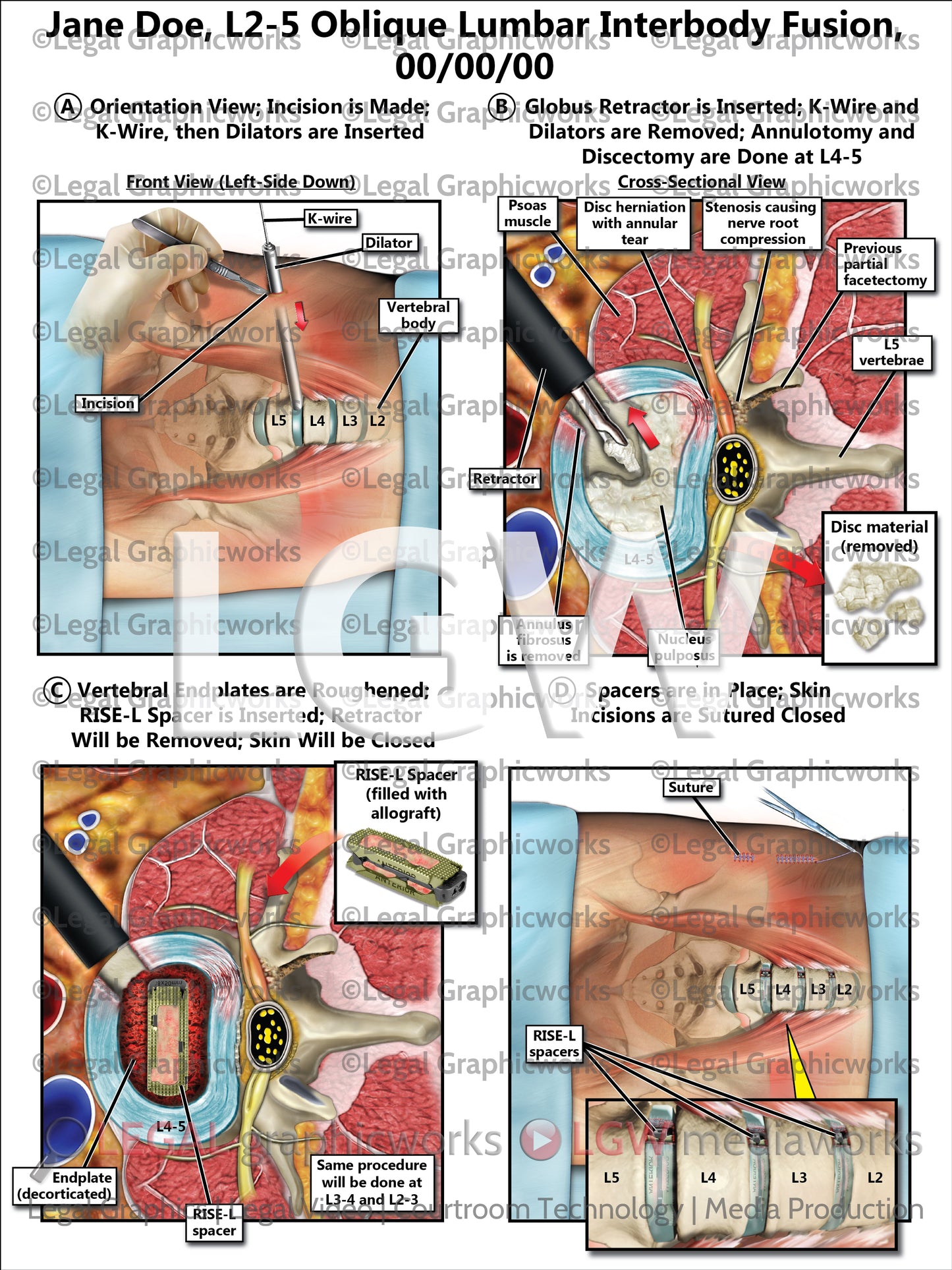 L2-5 Oblique Lumbar Interbody Fusion