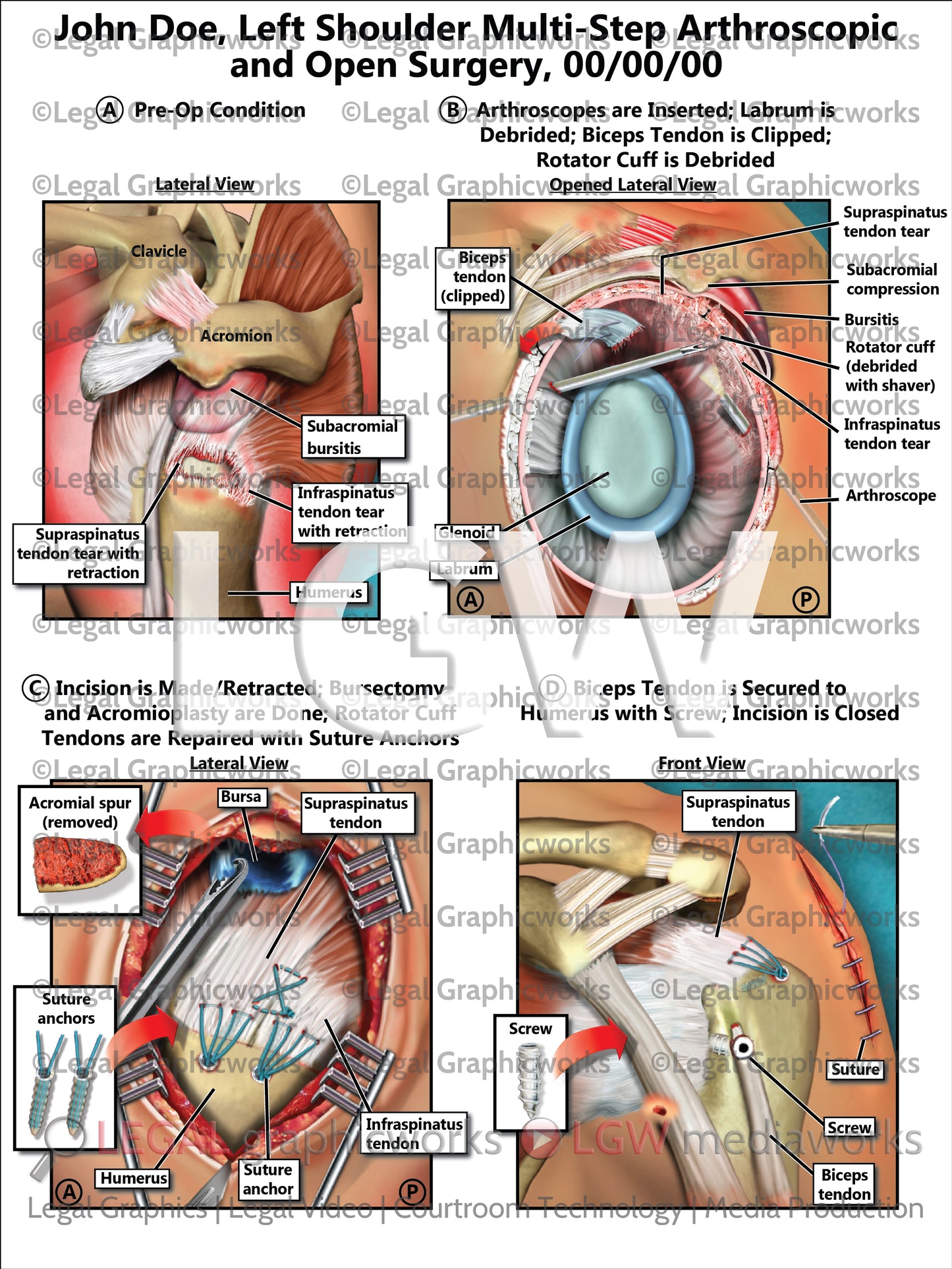 Left Shoulder Multi-Step Arthroscopic and Open Surgery
