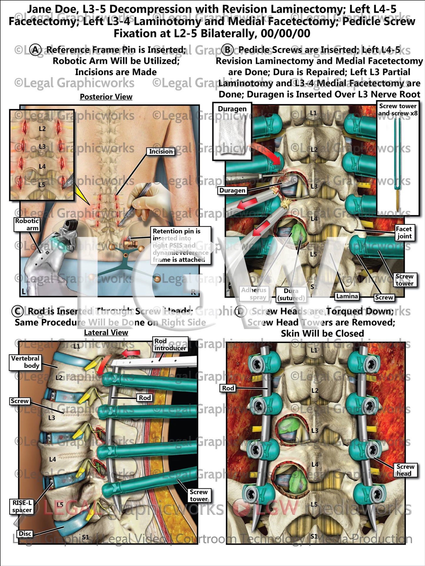 L3-5 Decompression with Revision Laminectomy; Left L4-5 Facetectomy; Left L3-4 Laminotomy and Medial Facetectomy; Pedicle Screw Fixation at L2-5 Bilaterally