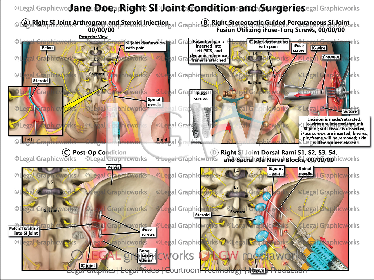 Right SI Joint Condition and Surgeries