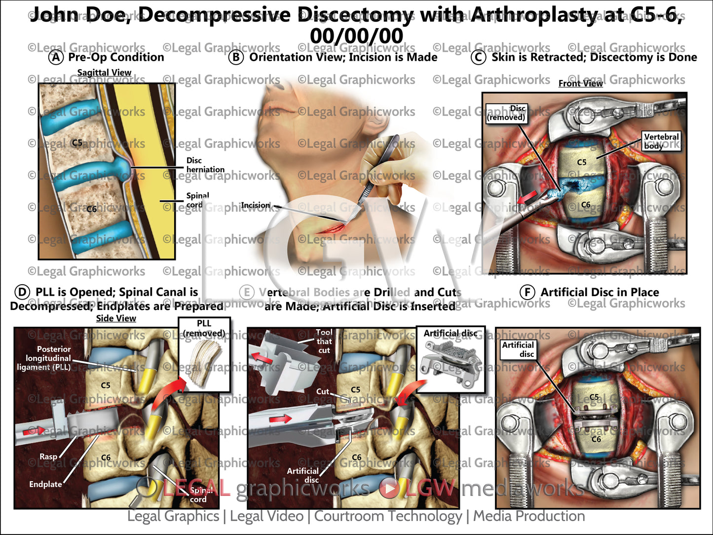 Decompressive Discectomy with Arthroplasty at C5-6