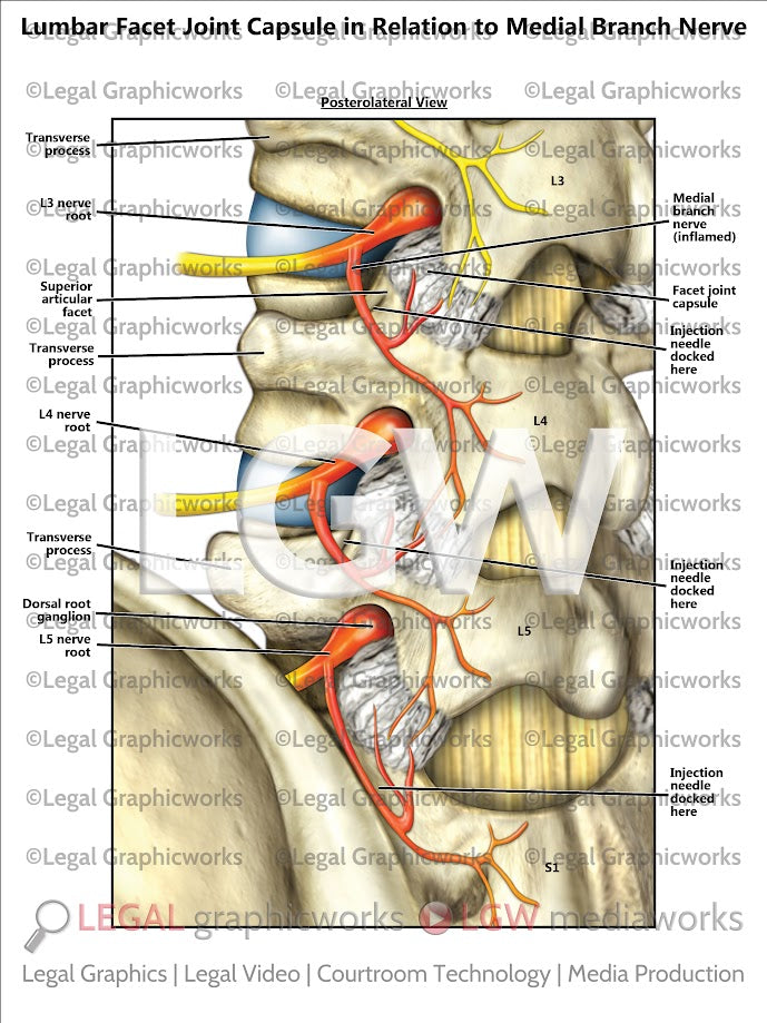Lumbar Facet Joint Capsule in Relation to Medial Branch Nerve