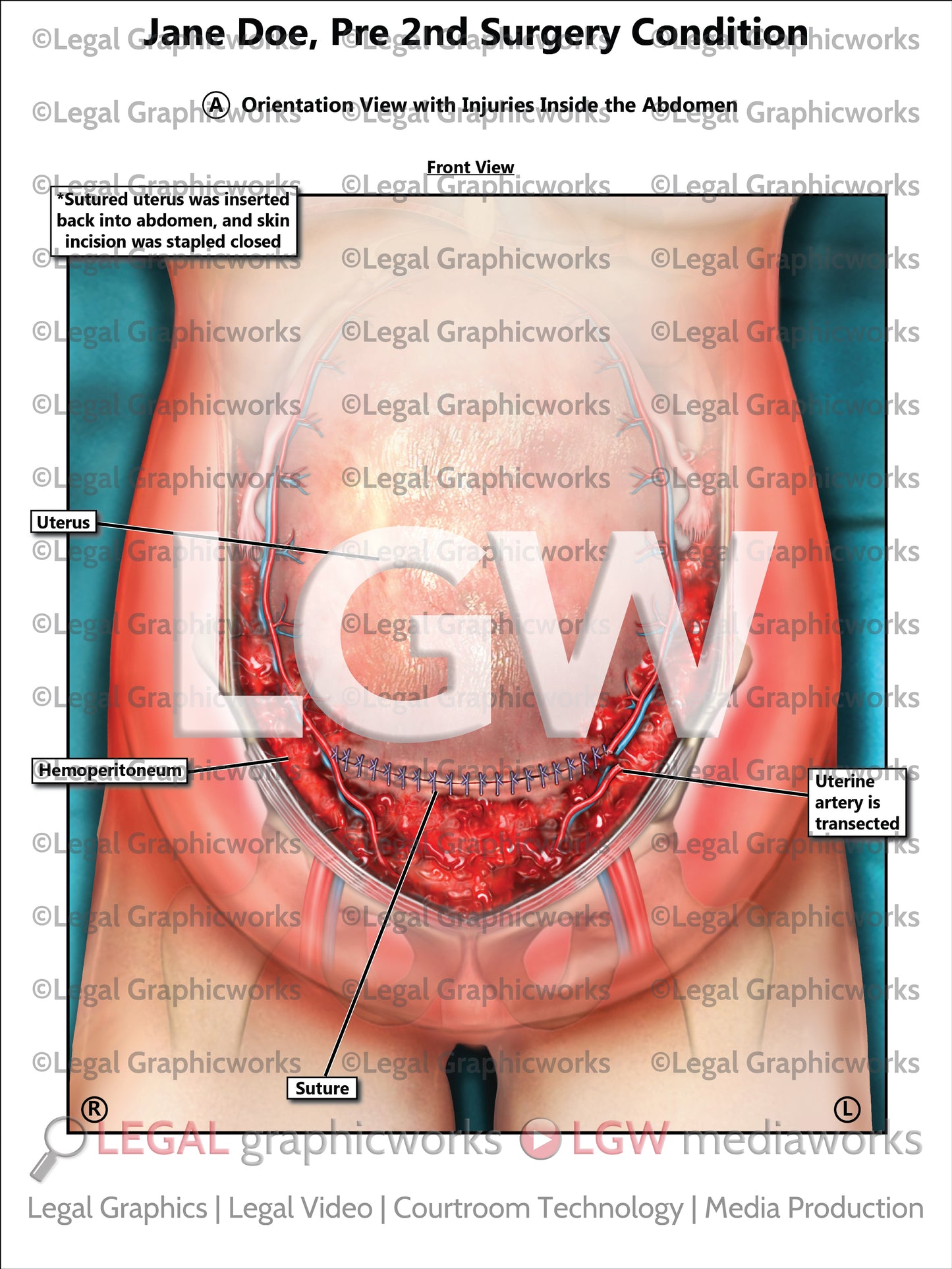 Pre 2nd Surgery Condition