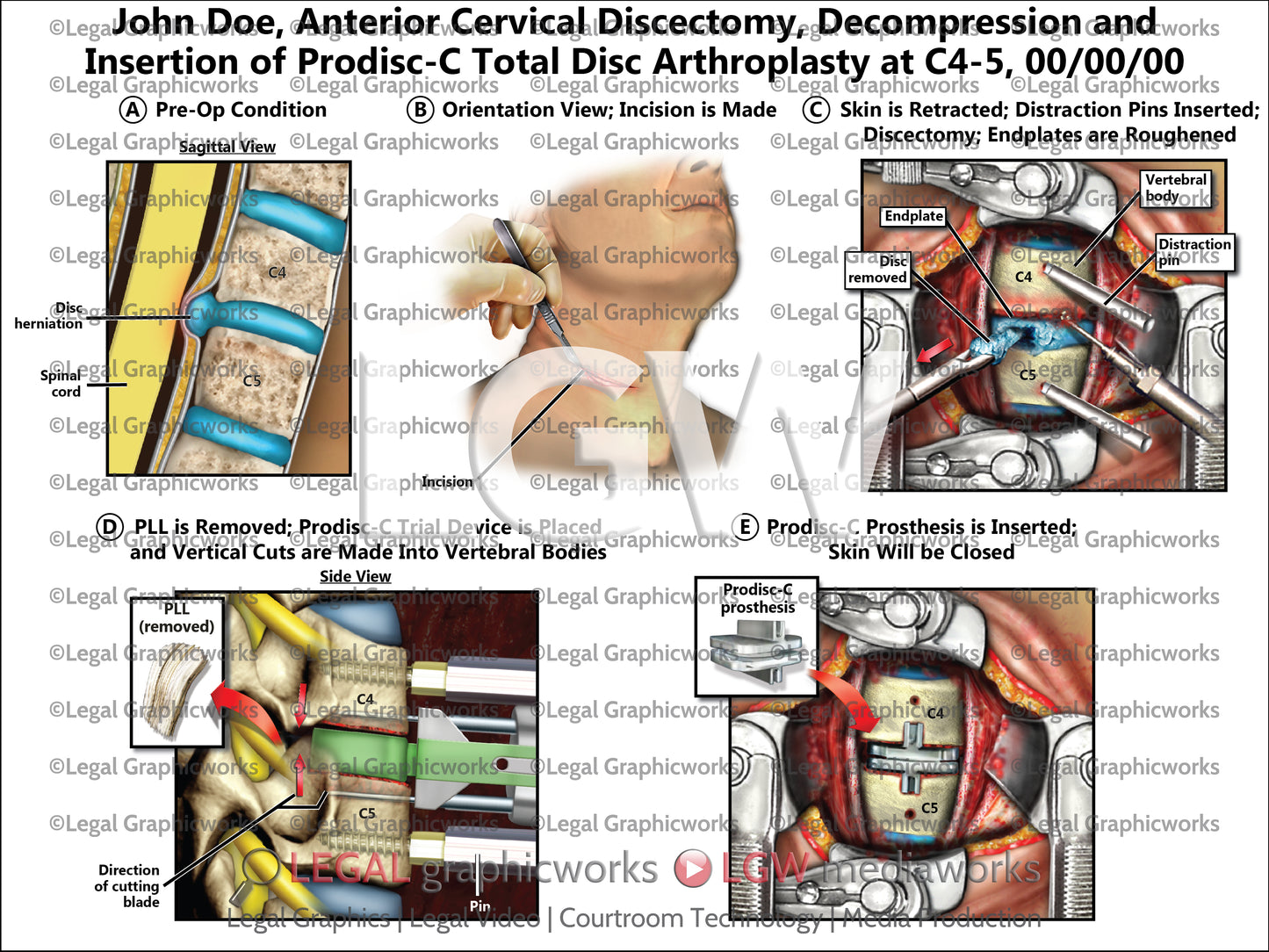Anterior Cervical Discectomy, Decompression and Insertion of Prodisc-C Total Disc Arthroplasty at C4-5