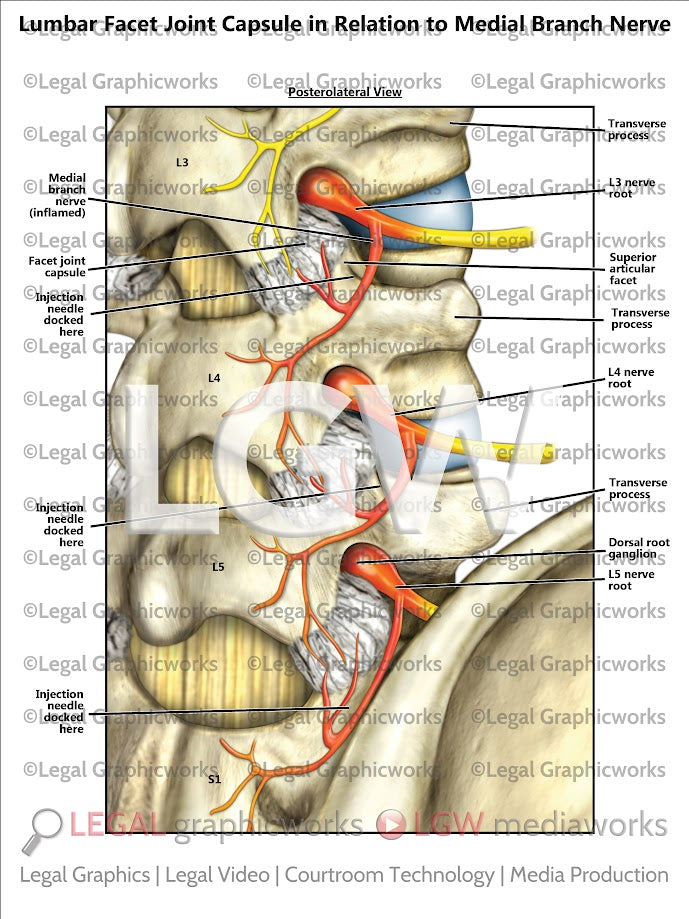 Lumbar Facet Joint Capsule in Relation to Medial Branch Nerve