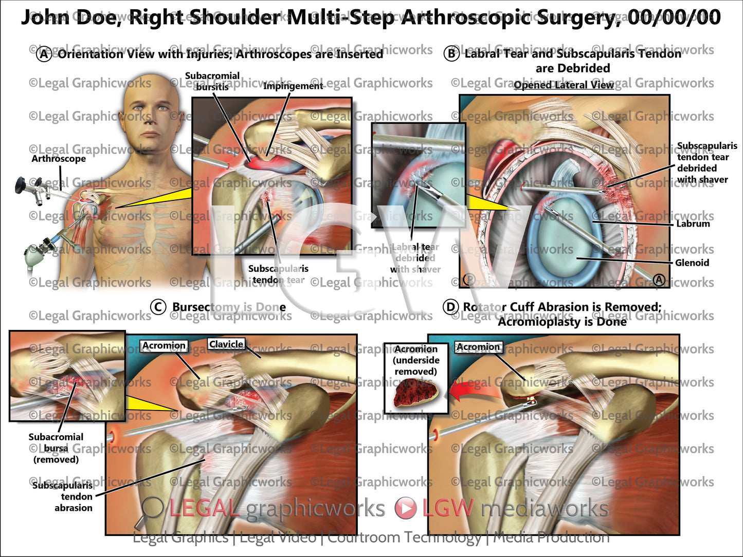 Right Shoulder Multi-Step Arthroscopic Surgery