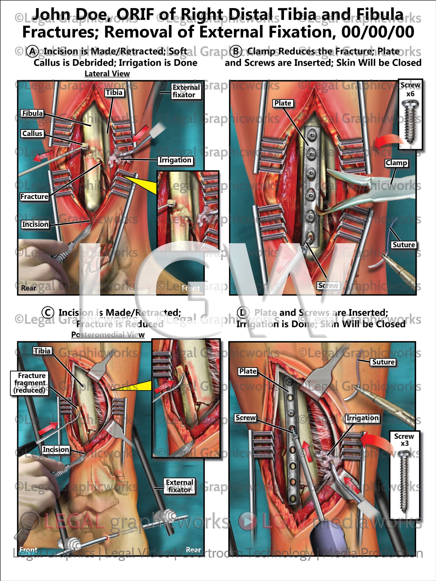 ORIF of Right Distal Tibia and Fibula Fractures; Removal of External Fixation