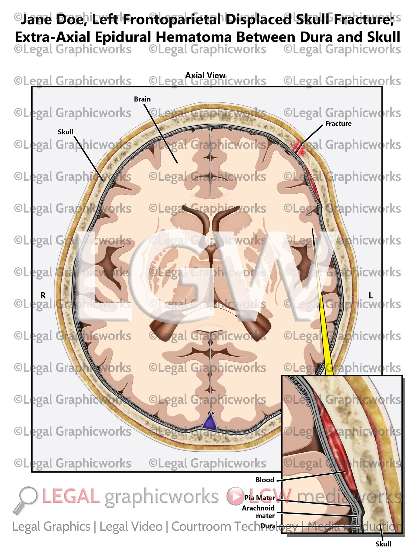 Left Frontoparietal Displaced Skull Fracture; Extra-Axial Epidural Hematoma Between Dura and Skull