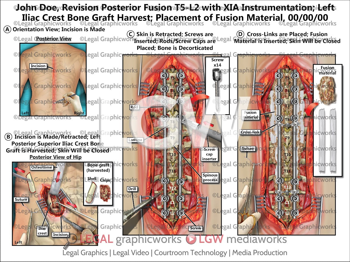 Revision Posterior Fusion T5-L2 with XIA Instrumentation; Left Iliac Crest Bone Graft Harvest; Placement of Fusion Material