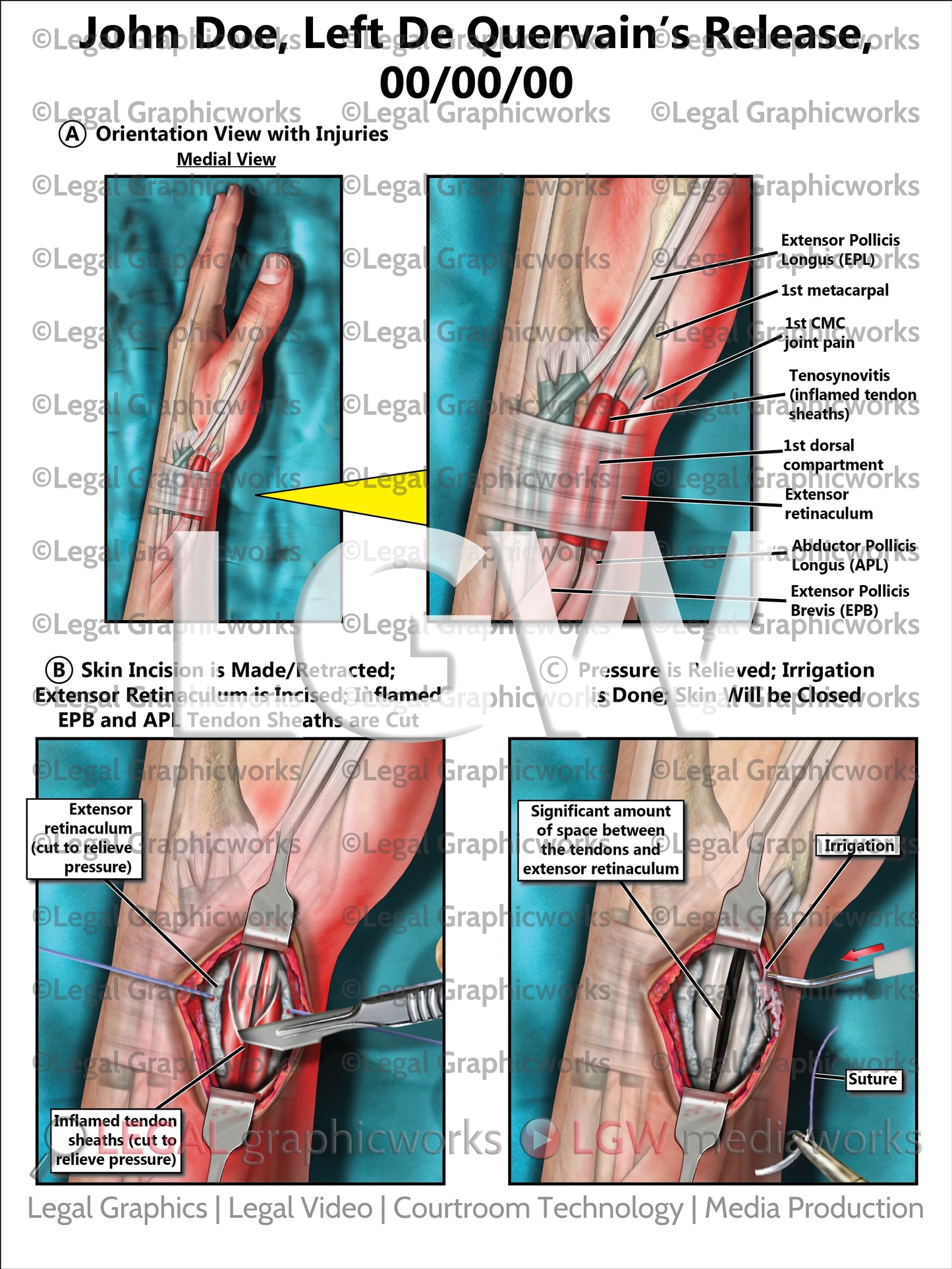 Left De Quervain's Release