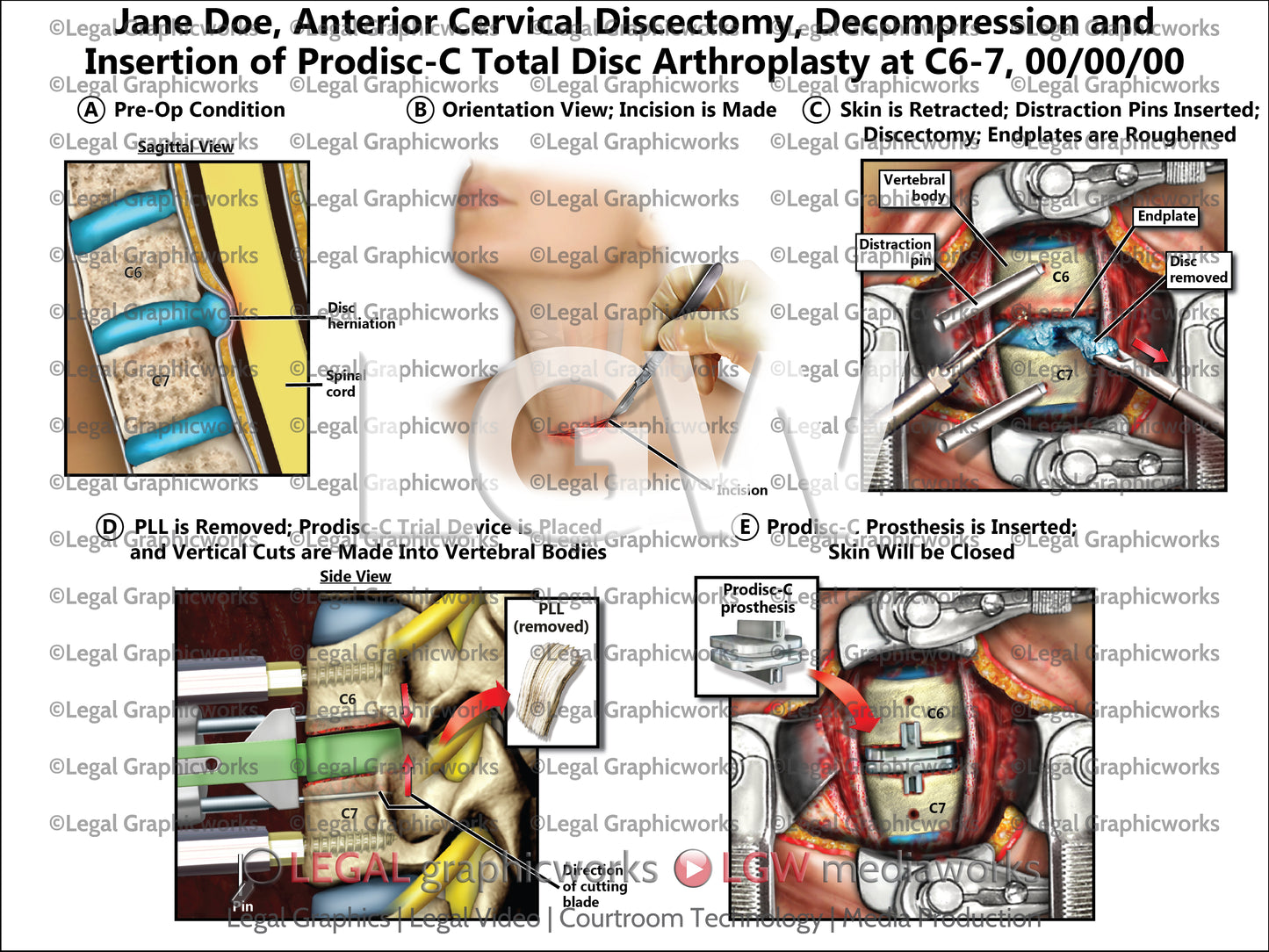 Anterior Cervical Discectomy, Decompression and Insertion of Prodisc-C Total Disc Arthroplasty at C6-7