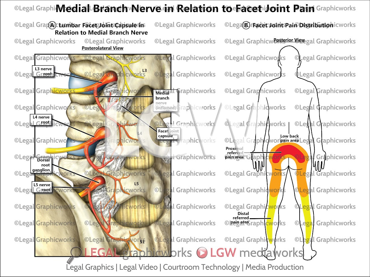 Medial Branch Nerve in Relation to Facet Joint Pain