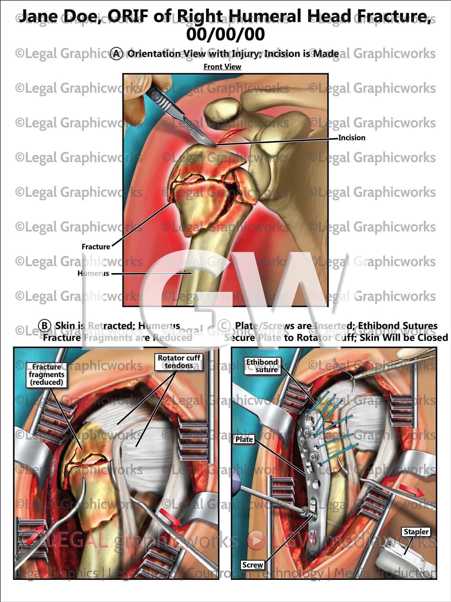 ORIF of Right Humeral Head Fracture