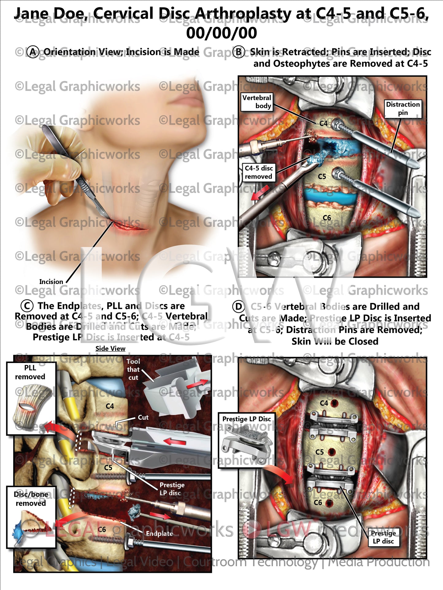 Cervical Disc Arthroplasty at C4-5 and C5-6
