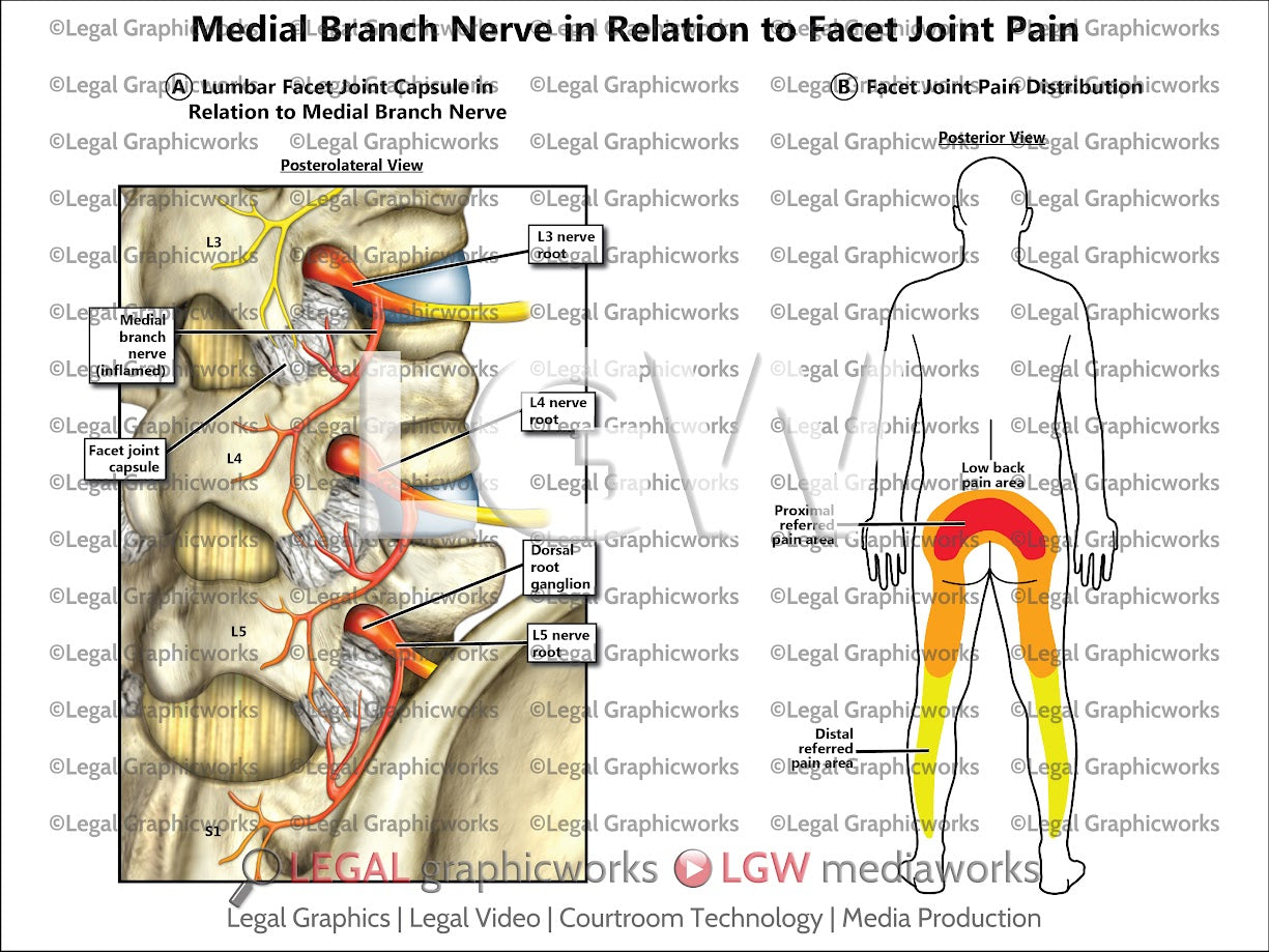 Medial Branch Nerve in Relation to Facet Joint Pain