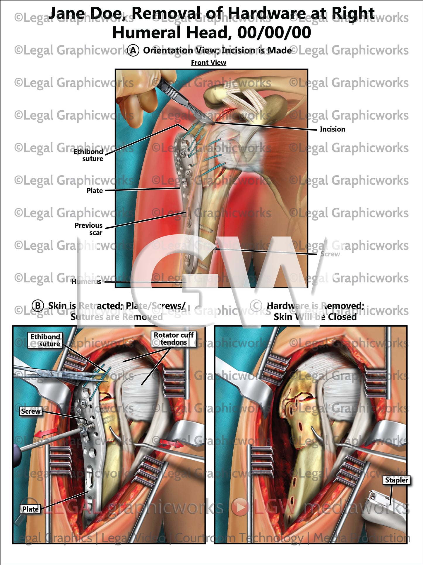Removal of Hardware at Right Humeral Head