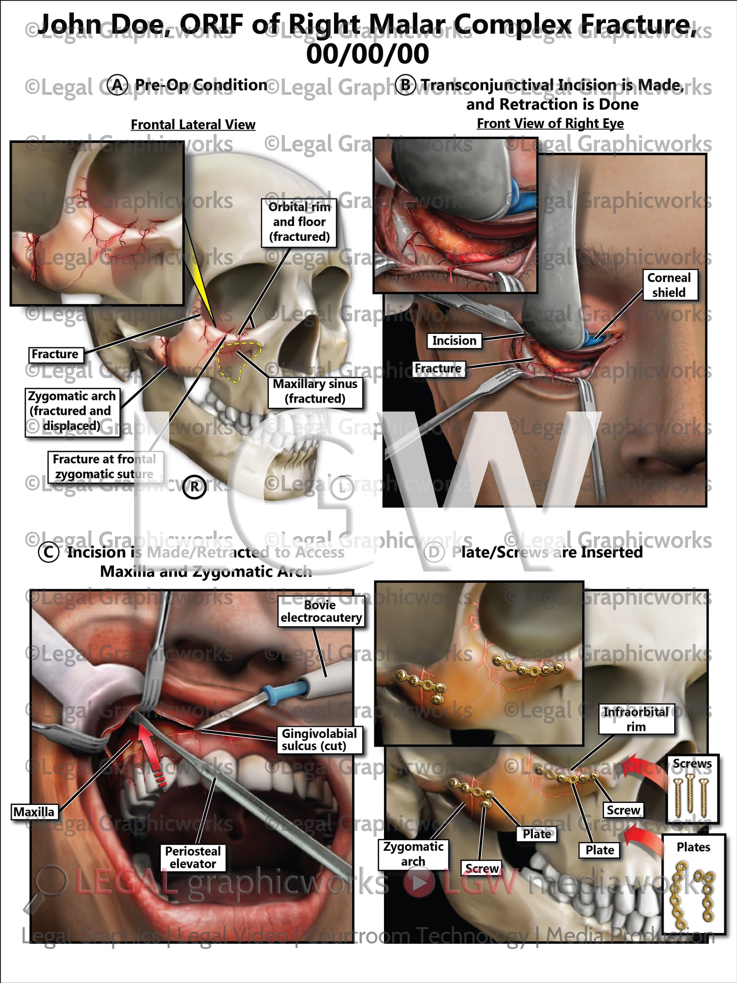 ORIF of Right Malar Complex Fracture