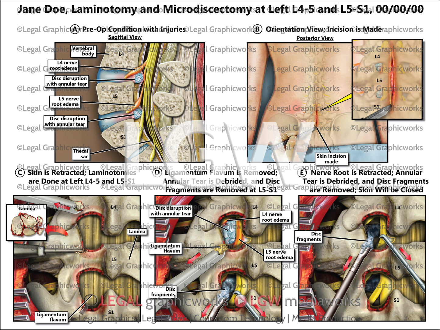 Laminotomy and Microdiscectomy at Left L4-5 and L5-S1