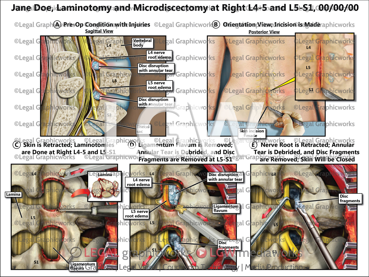Laminotomy and Microdiscectomy at Right L4-5 and L5-S1