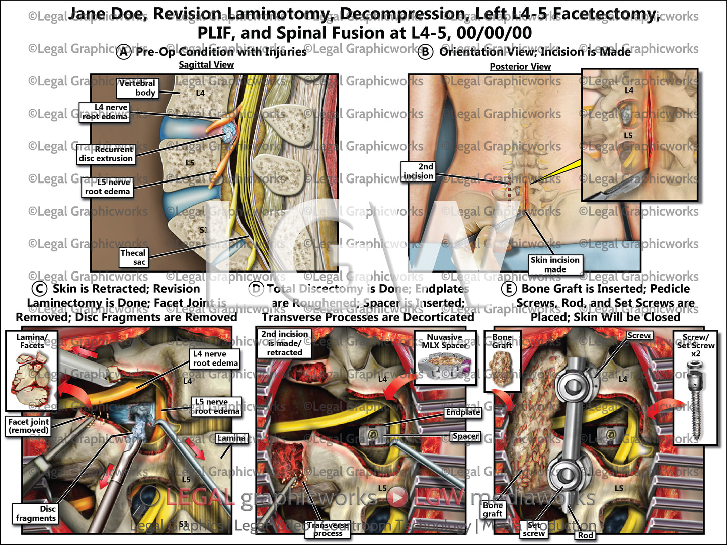 Revision Laminotomy, Decompression, Left L4-5 Facetectomy, PLIF, and Spinal Fusion at L4-5