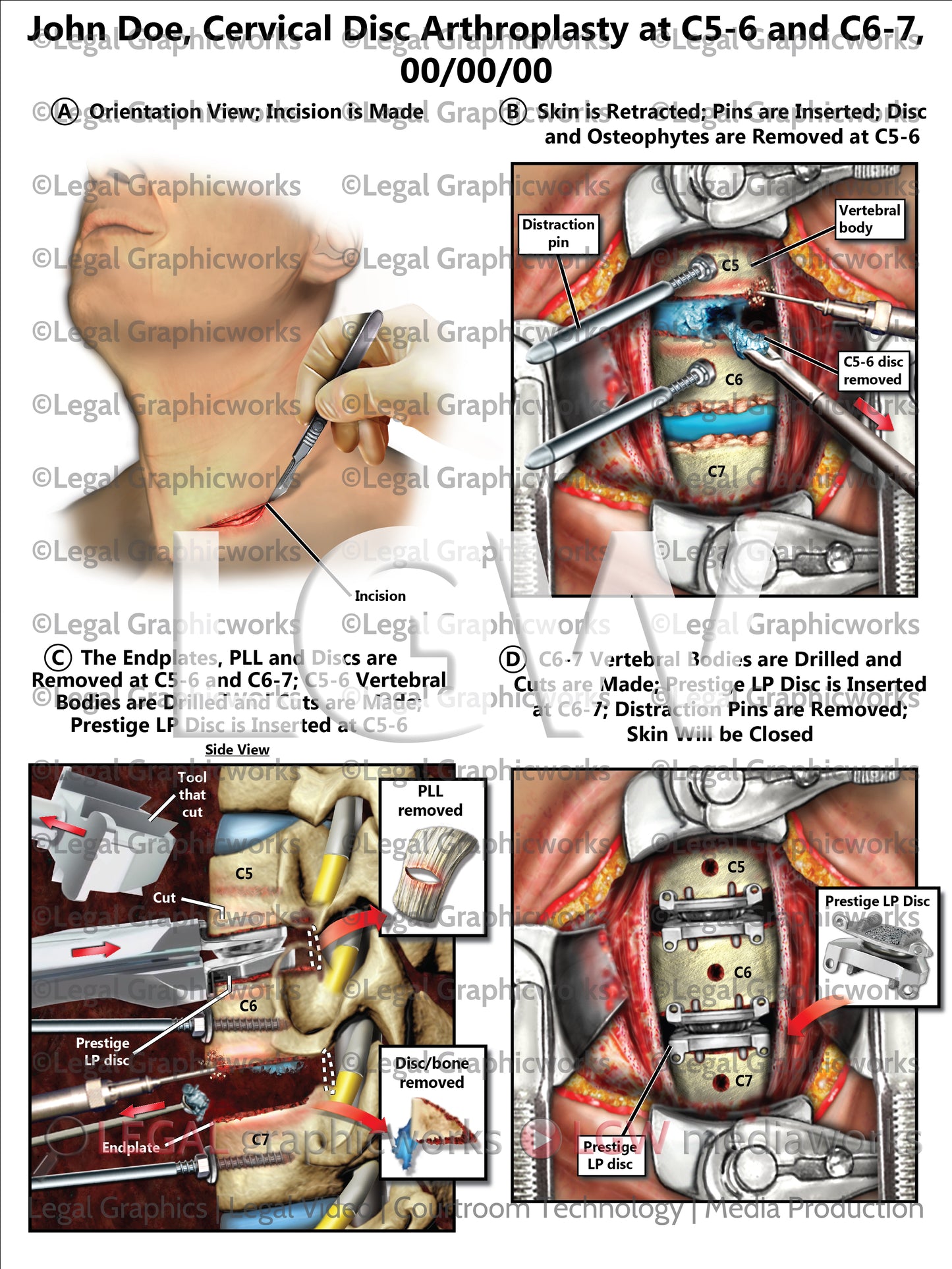 Cervical Disc Arthroplasty at C5-6 and C6-7