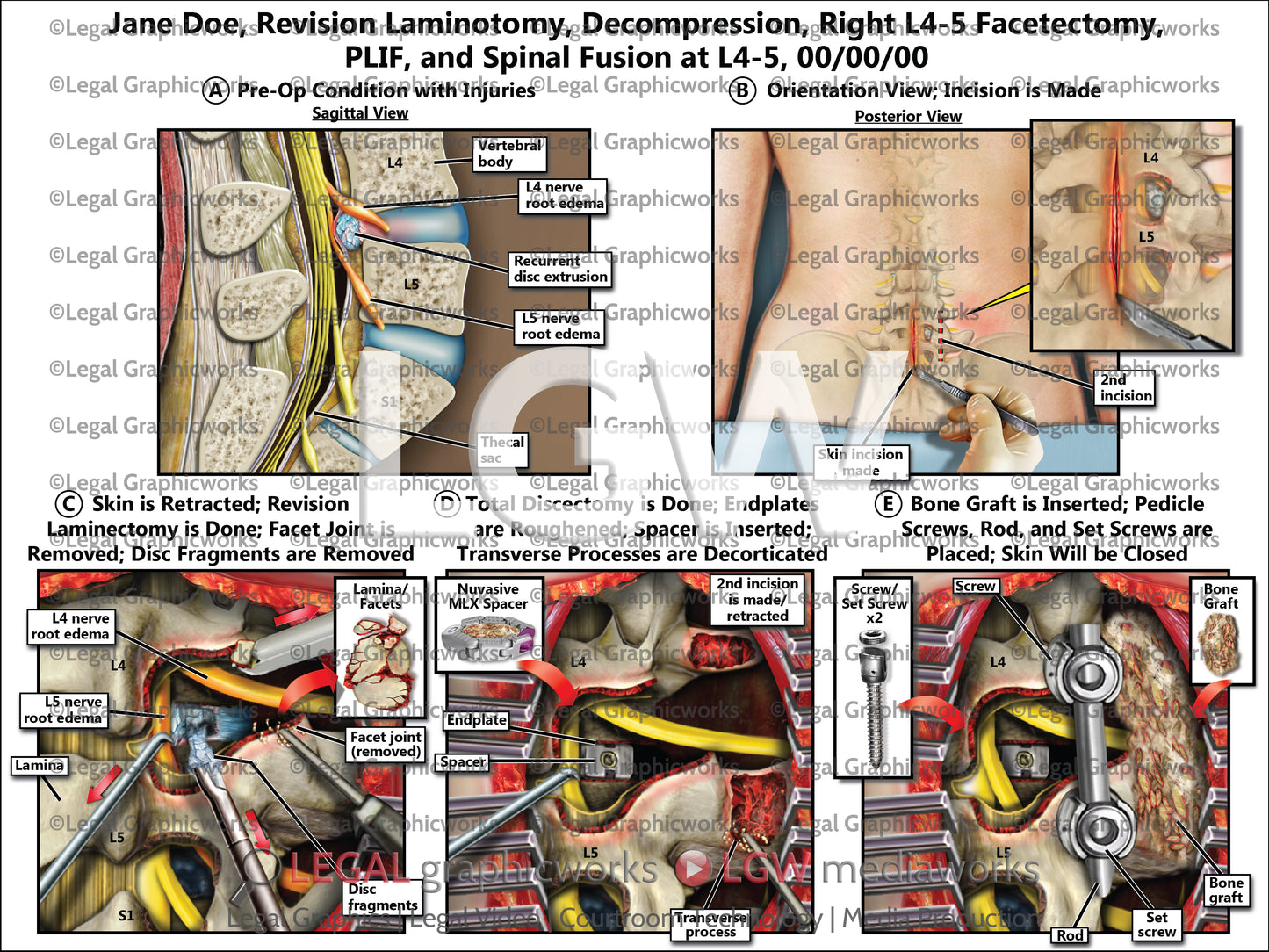 Revision Laminotomy, Decompression, Right L4-5 Facetectomy, PLIF, and Spinal Fusion at L4-5