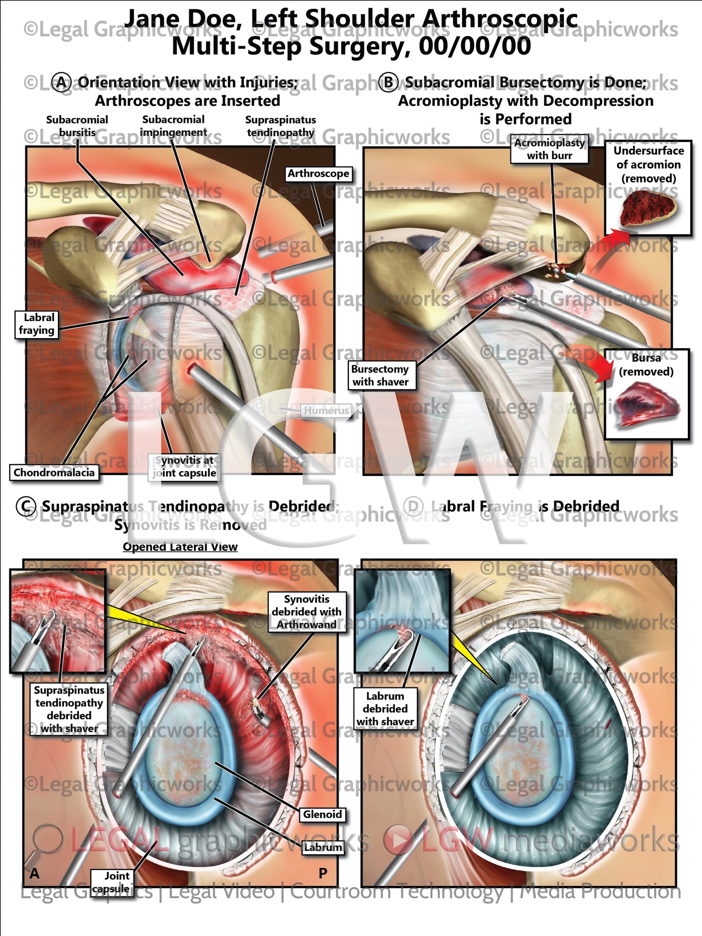 Left Shoulder Arthroscopic Multi-Step Surgery
