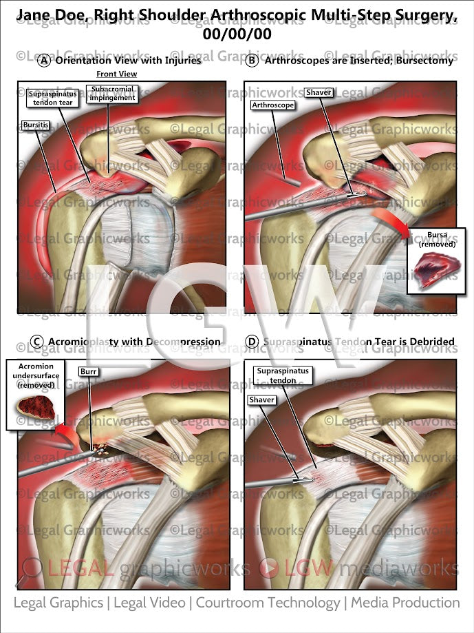 Right Shoulder Arthroscopic Multi-Step Surgery