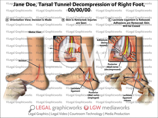 Tarsal Tunnel Decompression of Right Foot