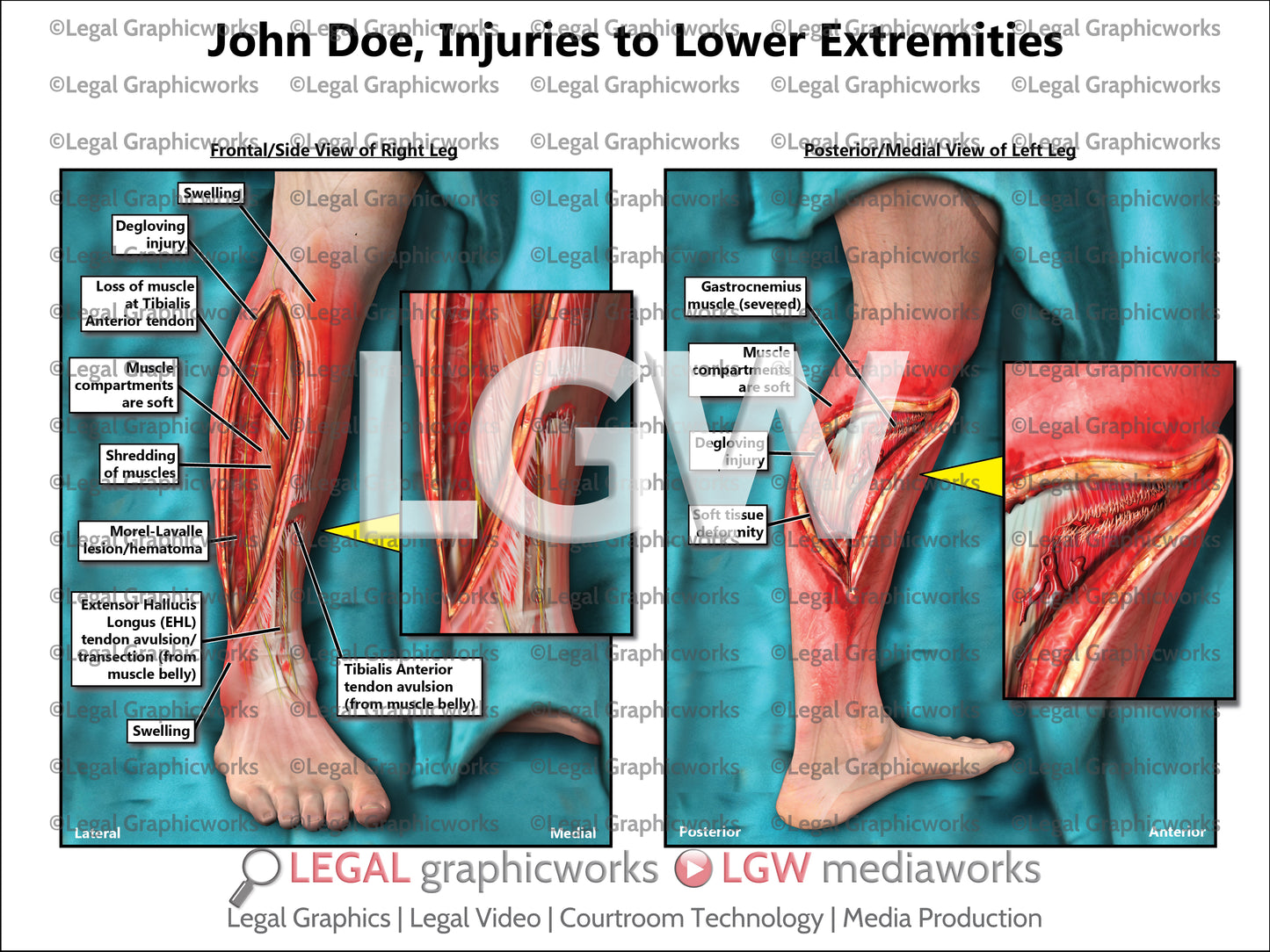 Injuries to Lower Extremities
