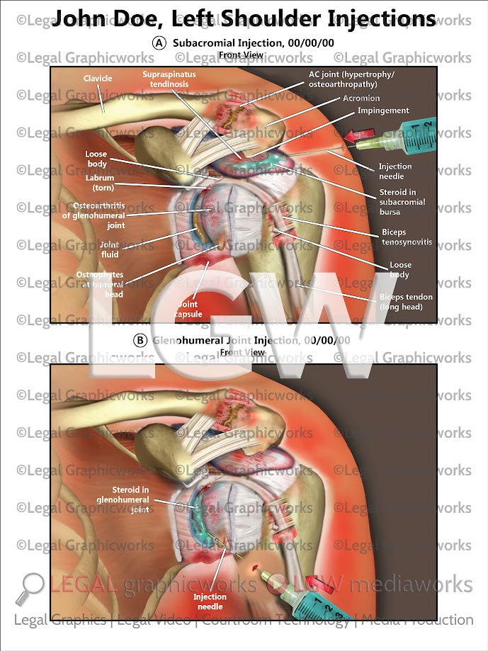 Left Shoulder Injections