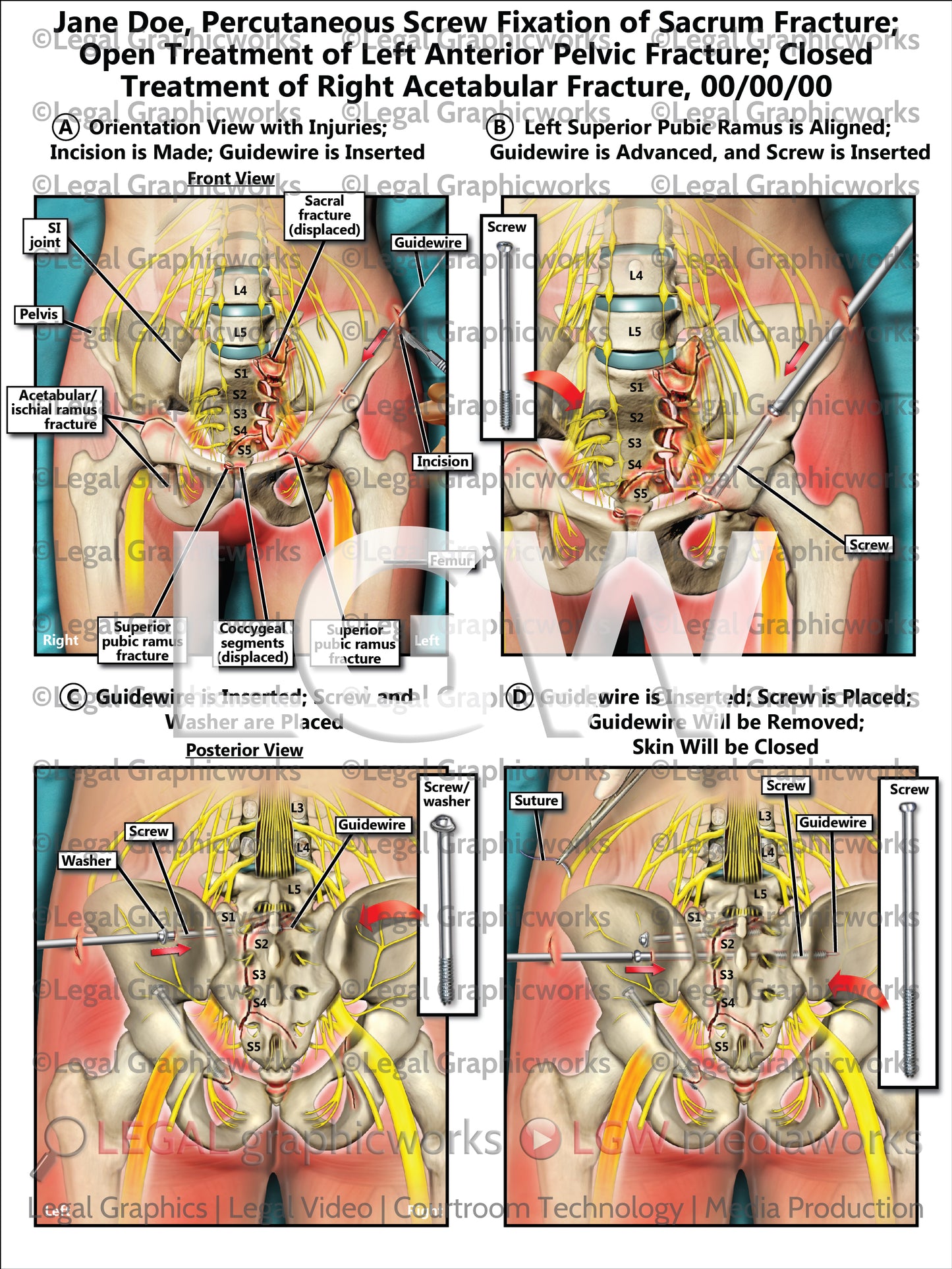 Percutaneous Screw Fixation of Sacrum Fracture; Open Treatment of Left Anterior Pelvic Fracture; Closed Treatment of Right Acetabular Fracture