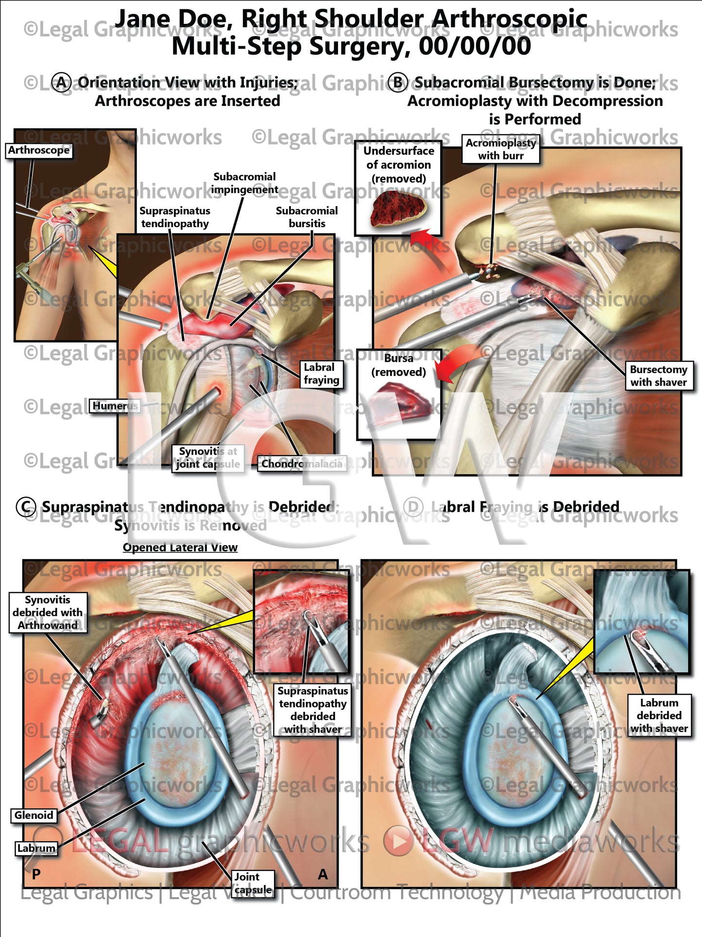 Right Shoulder Arthroscopic Multi-Step Surgery