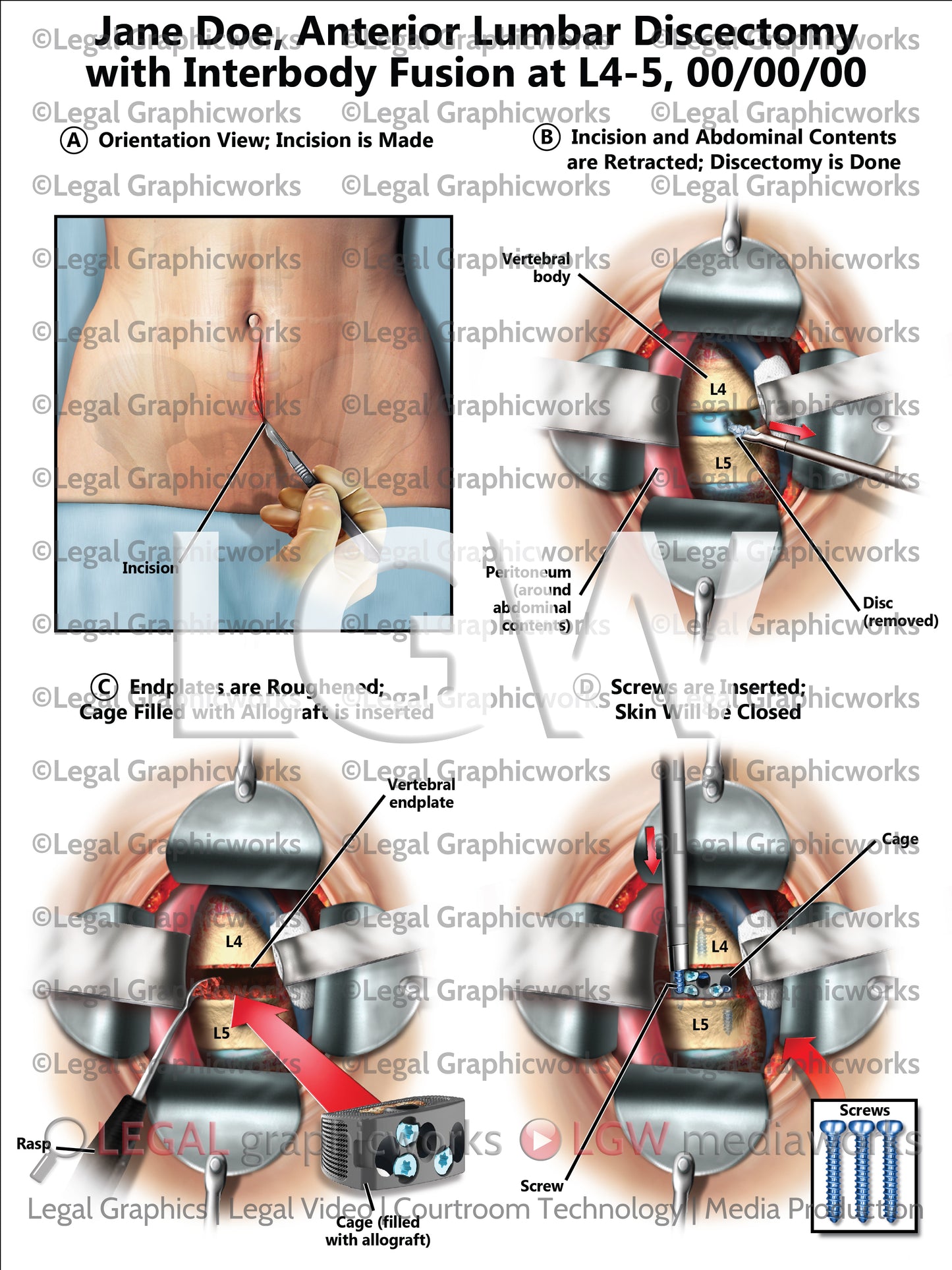 Anterior Lumbar Discectomy with Interbody Fusion at L4-5