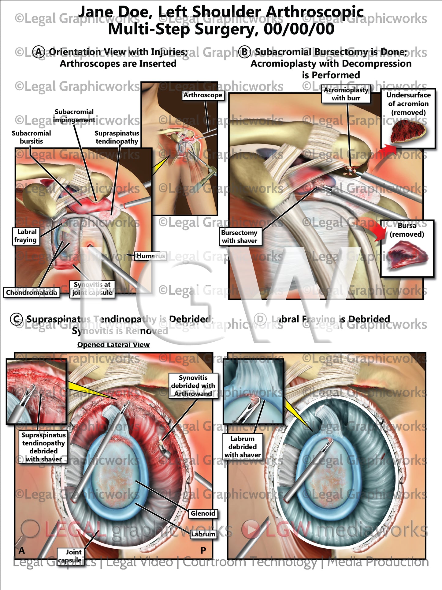 Left Shoulder Arthroscopic Multi-Step Surgery