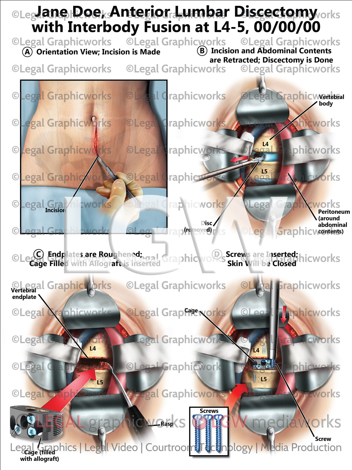 Anterior Lumbar Discectomy with Interbody Fusion at L4-5