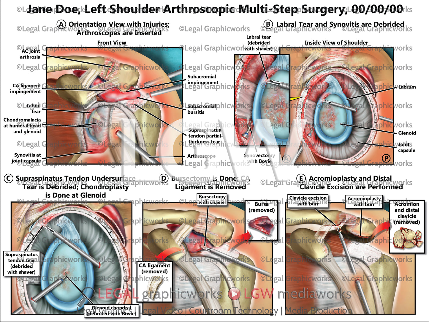 Left Shoulder Arthroscopic Multi-Step Surgery