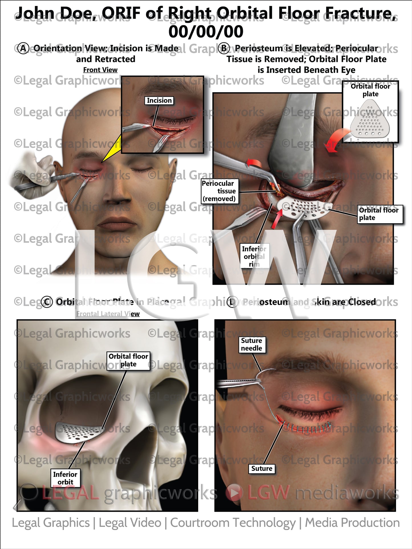ORIF of Right Orbital Floor Fracture