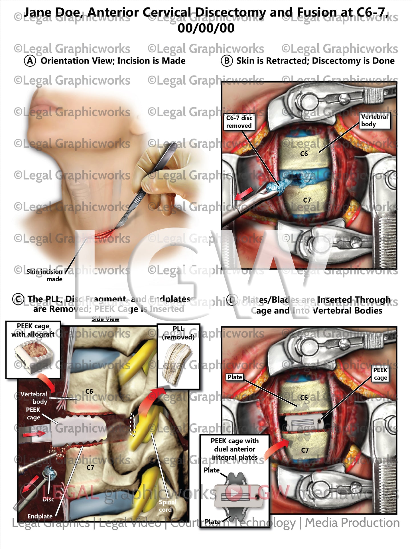 Anterior Cervical Discectomy and Fusion at C6-7