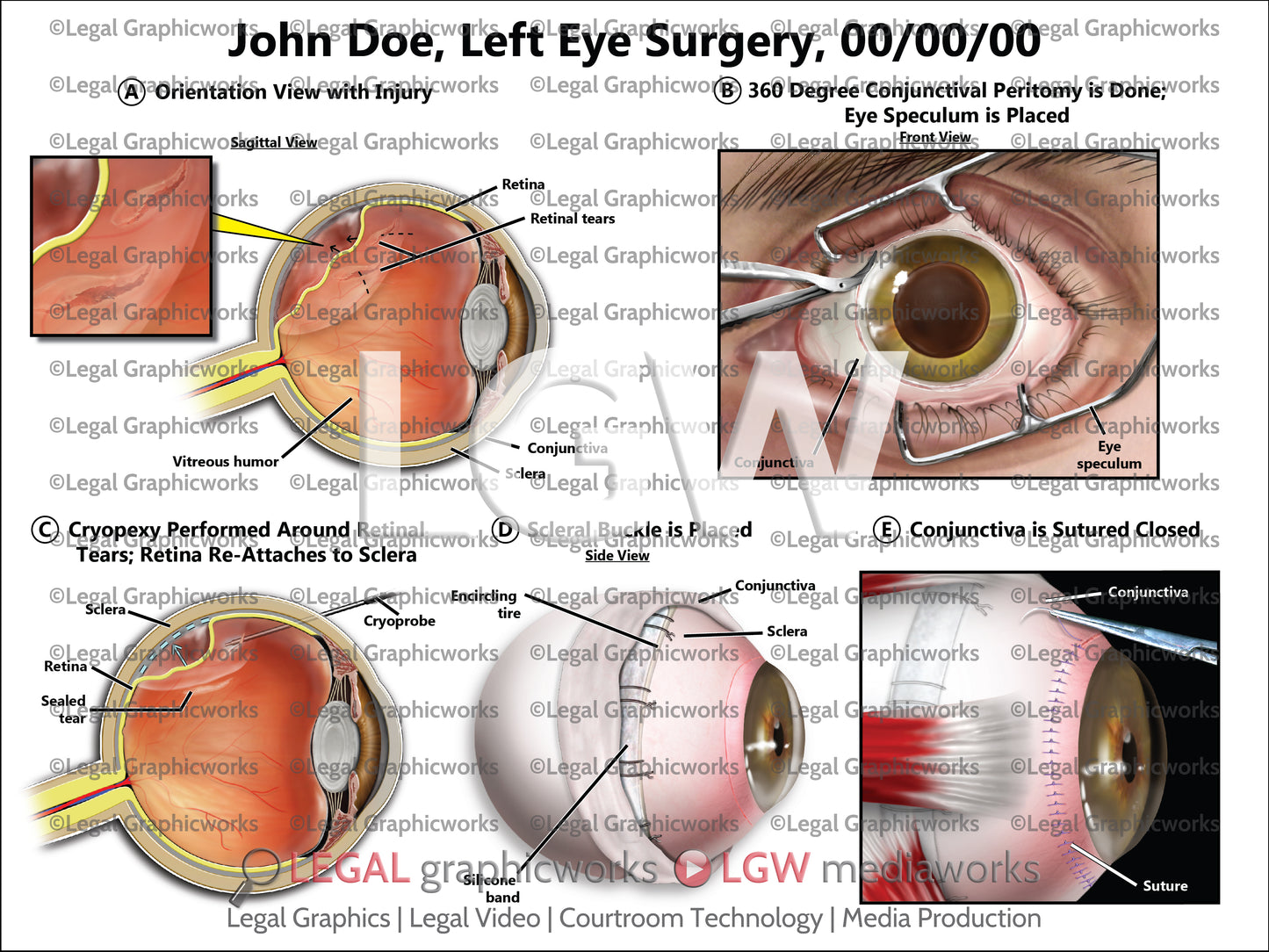 Left Eye Surgery