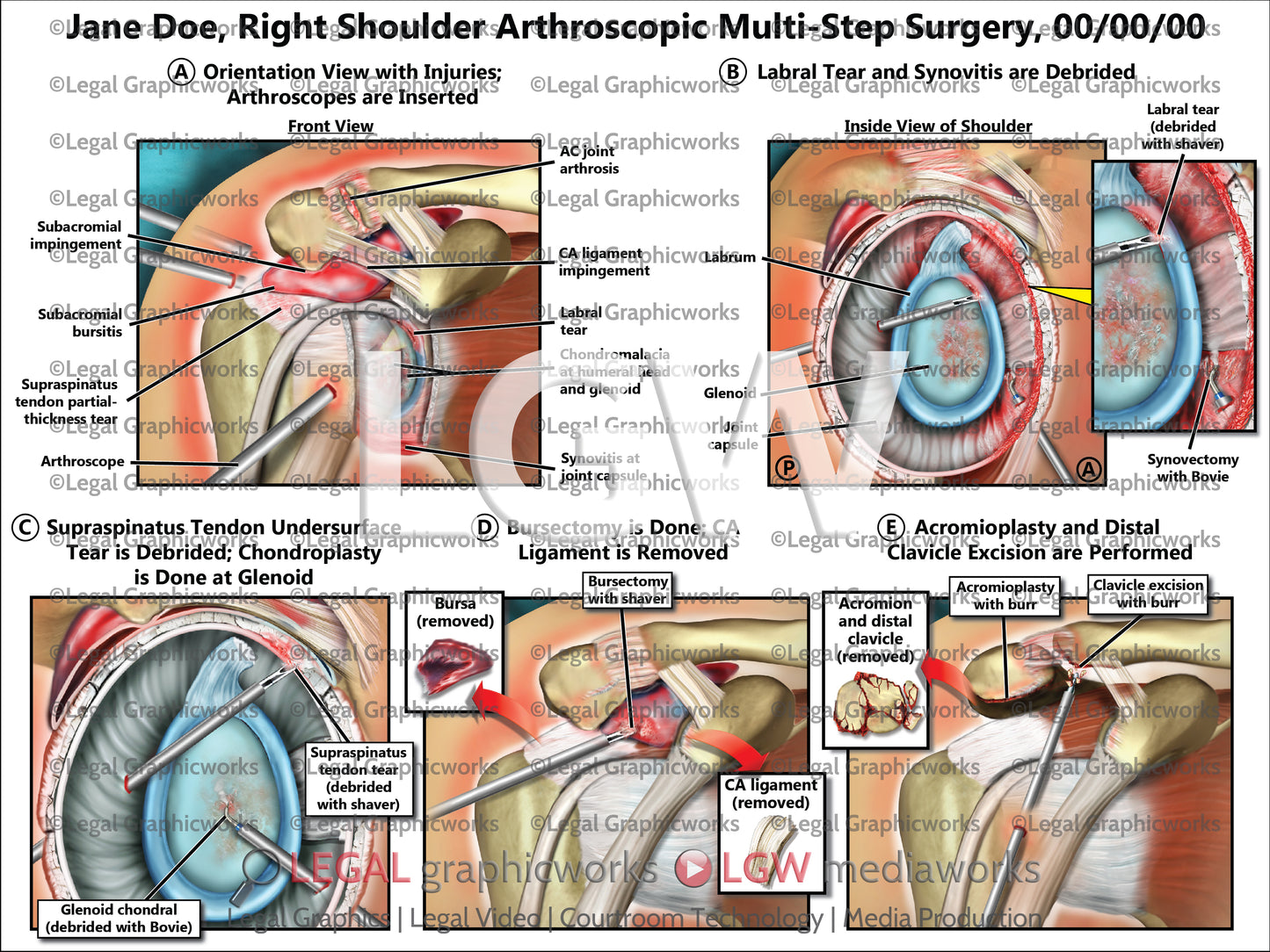 Right Shoulder Arthroscopic Multi-Step Surgery