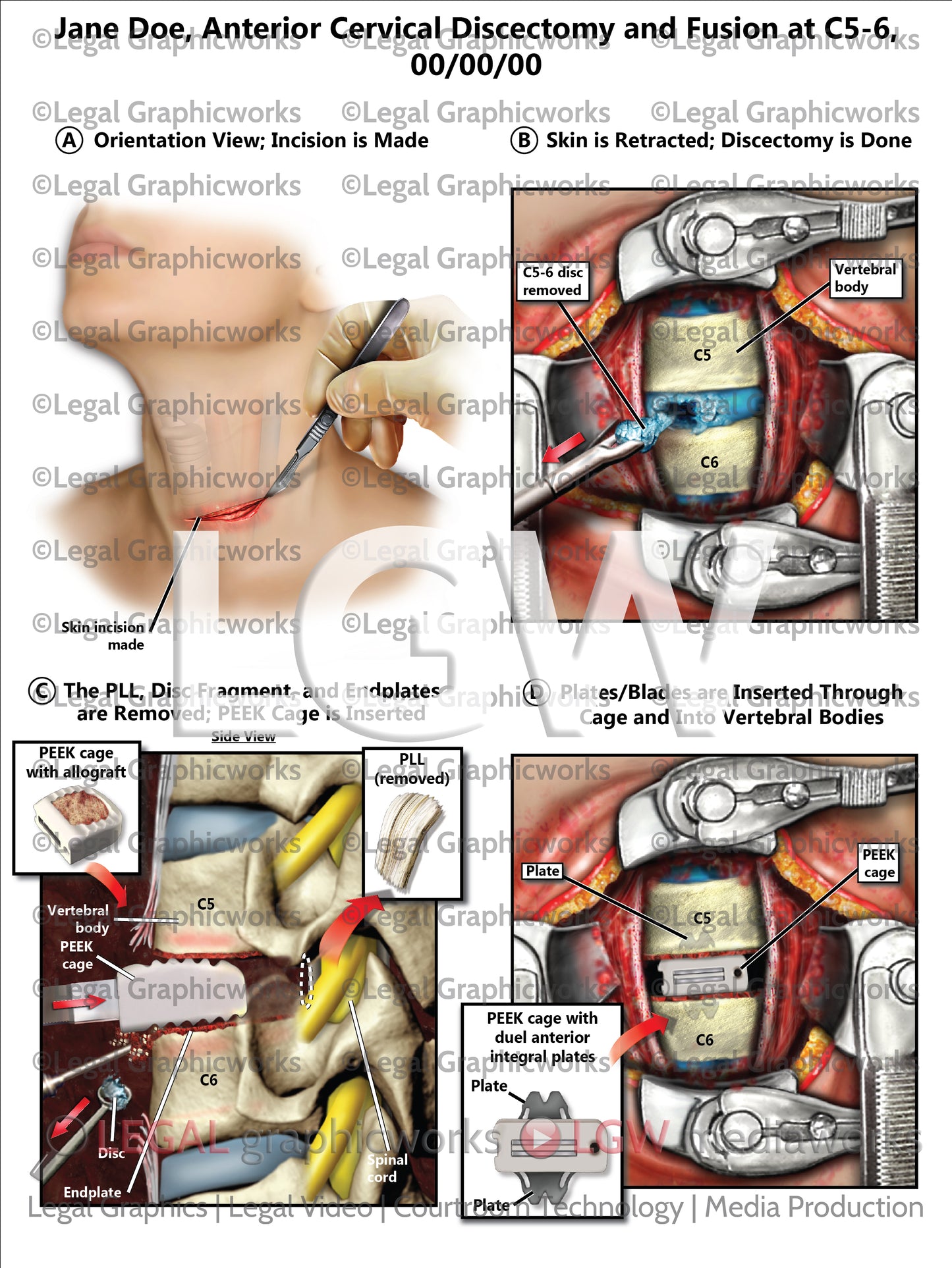 Anterior Cervical Discectomy and Fusion at C5-6