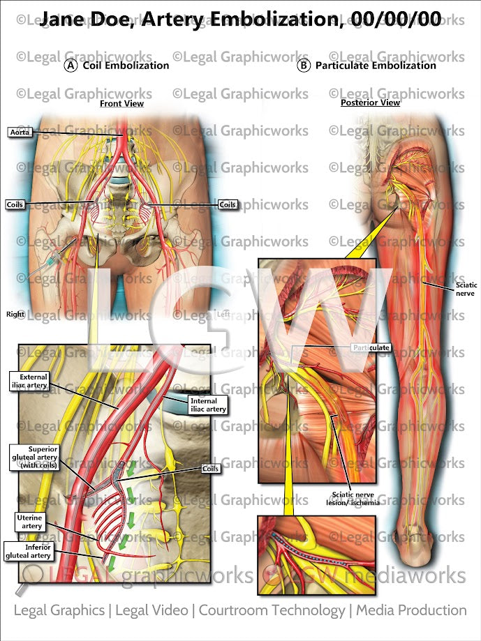 Artery Embolization