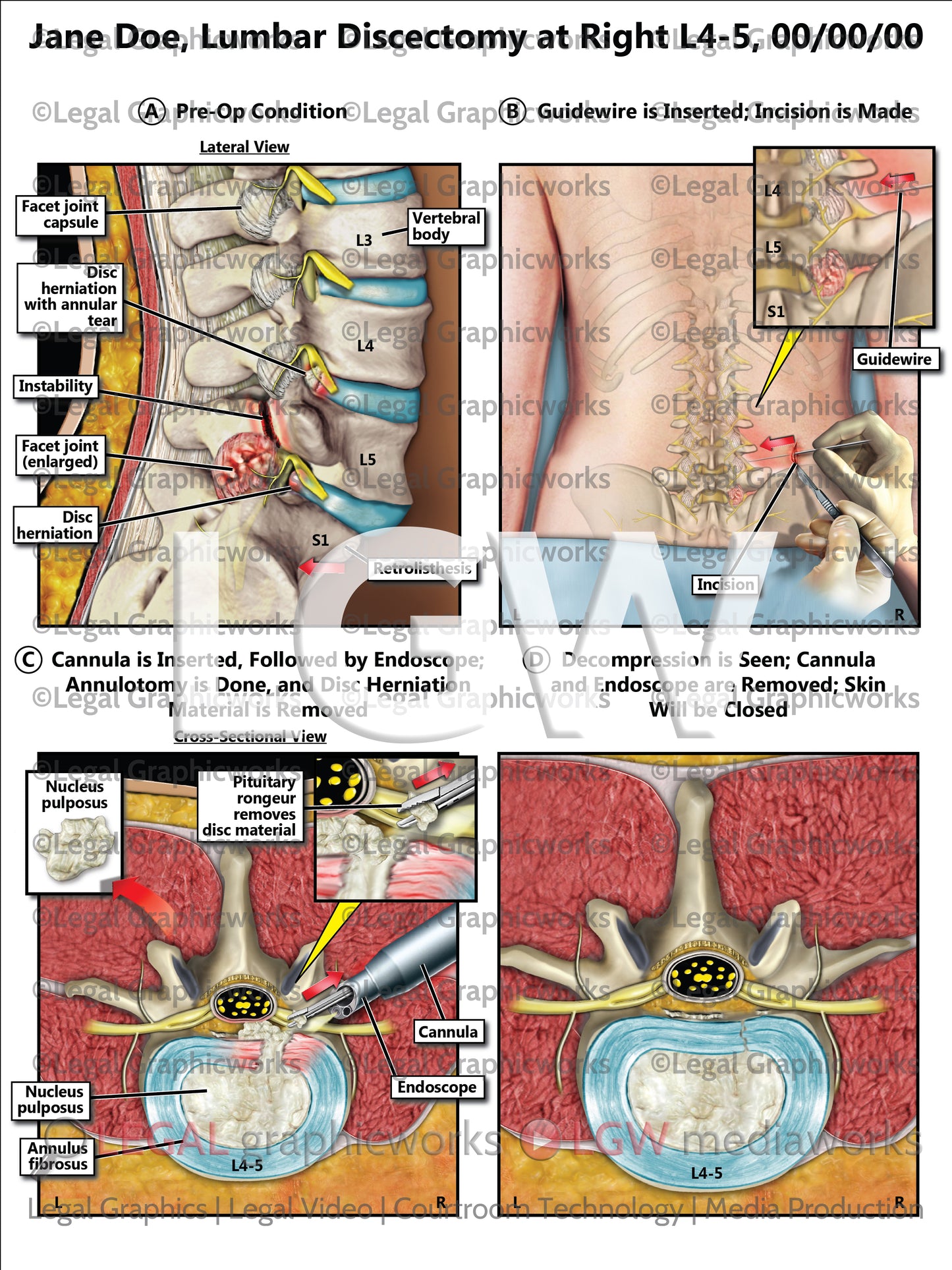 Lumbar Discectomy at Right L4-5