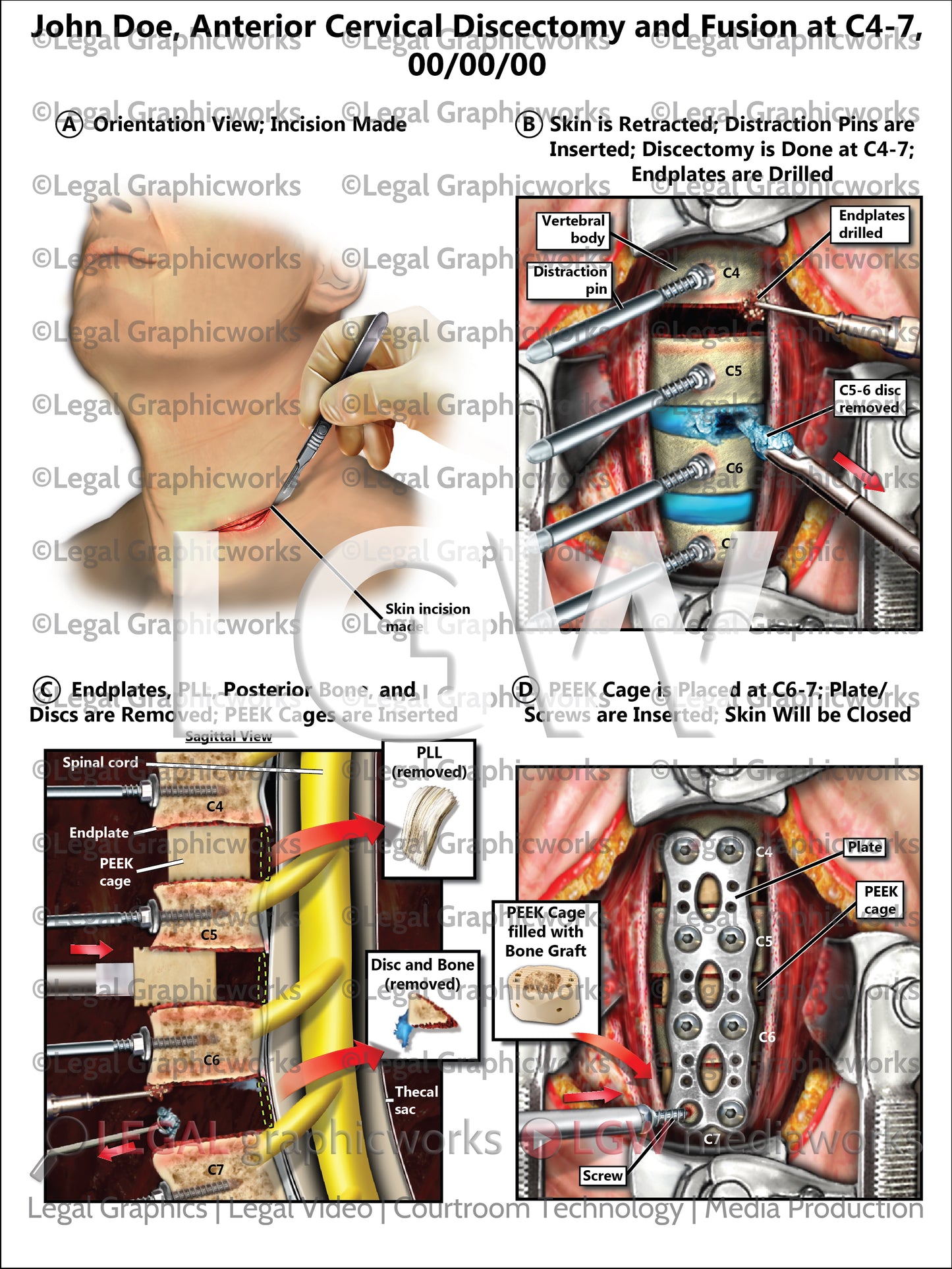 Anterior Cervical Discectomy and Fusion at C4-7