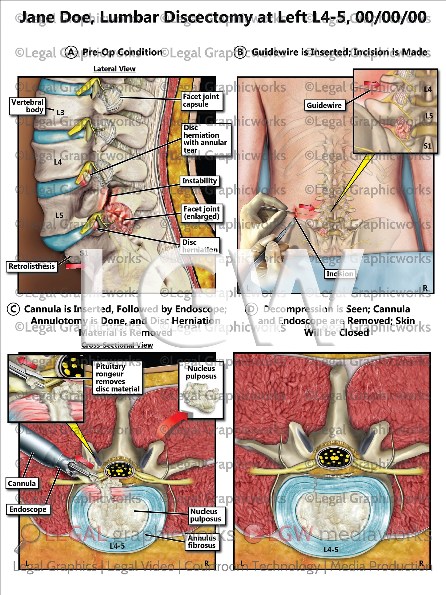 Lumbar Discectomy at Left L4-5